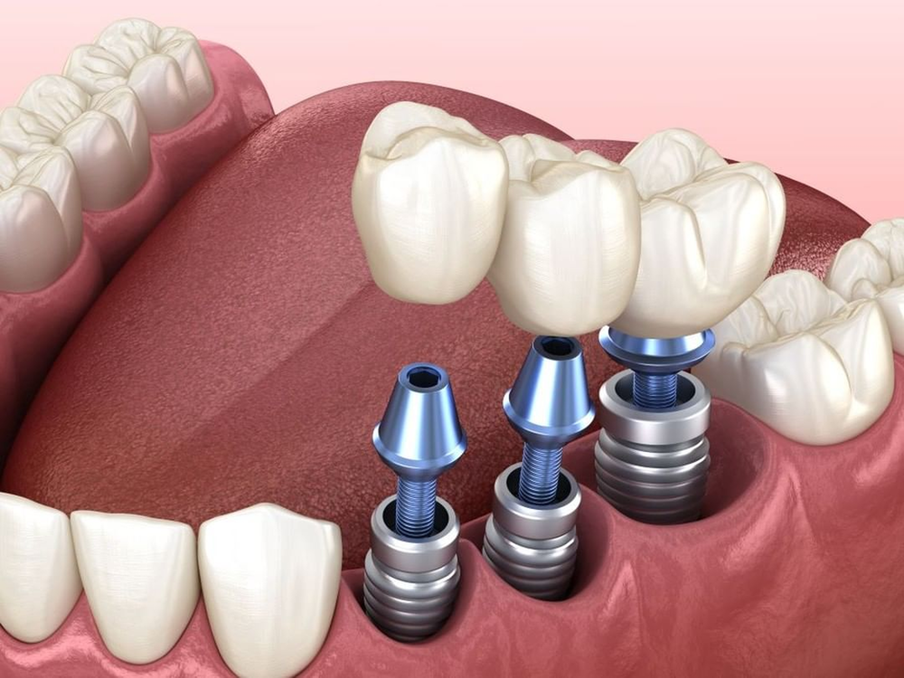 dental implants kingsford