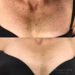 laser pigmentation removal sydney cbd