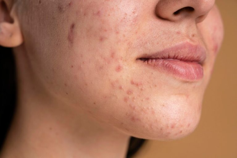True Scars Smooth Skin Ahead: Navigating the Treatment of Acne Scars in Burwood