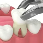 tooth extraction westmead