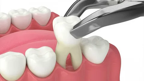 tooth extraction westmead