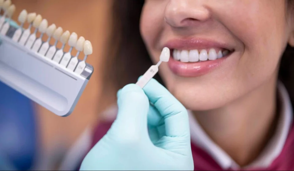 Veneers Epping